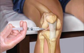 iniezione intra-articolare nell'articolazione nell'osteoartrite