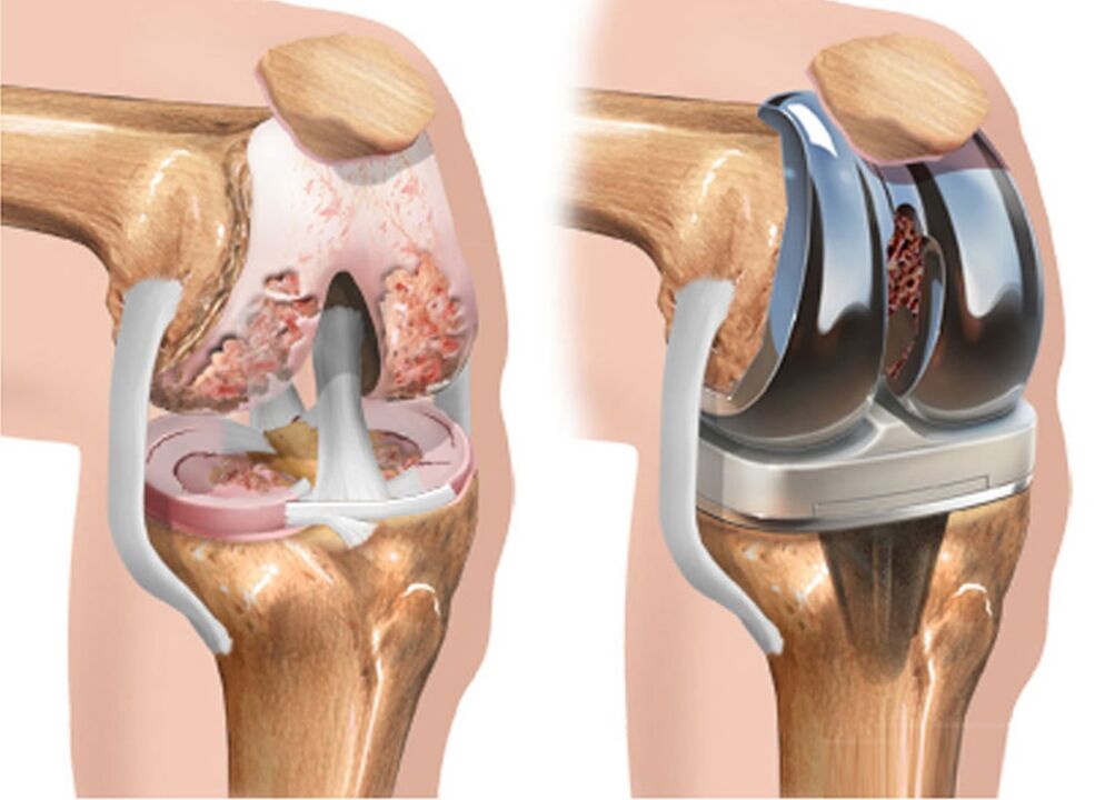 prima e dopo l'artrosi dell'articolazione del ginocchio nell'artrosi