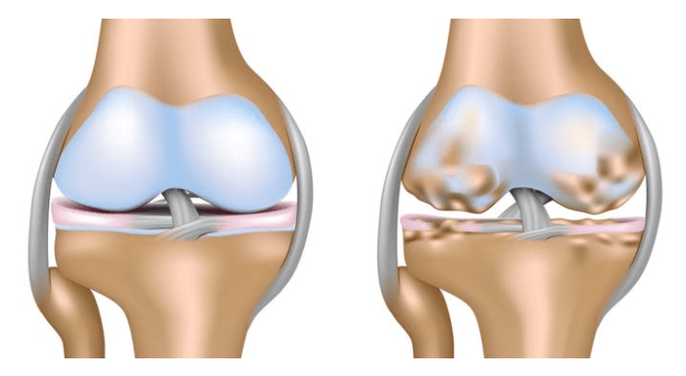 cartilagine sana e danni all'articolazione del ginocchio nell'osteoartrosi