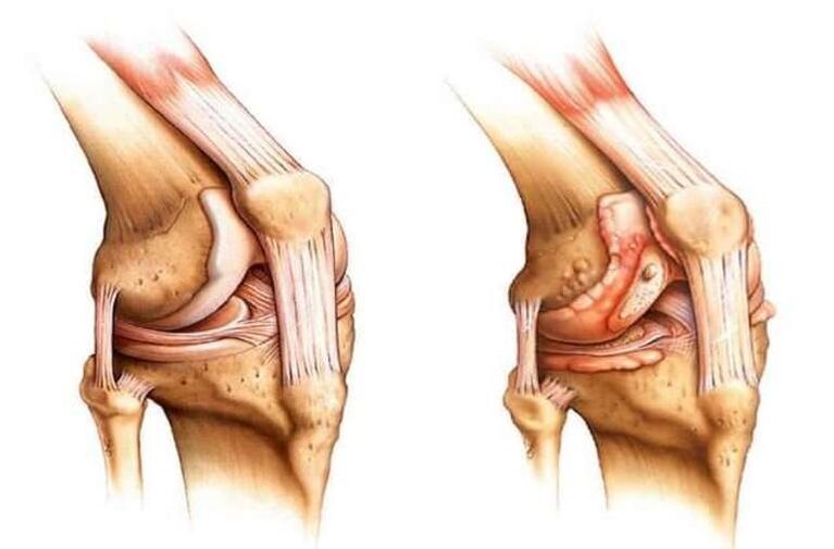 ginocchio sano e artrosi dell'articolazione del ginocchio