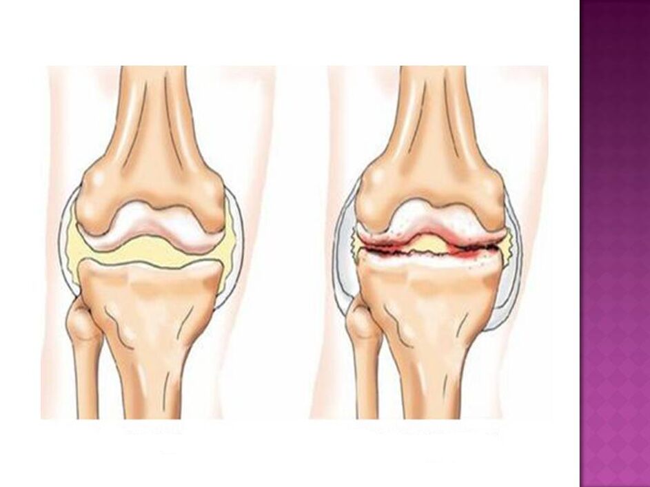 L'articolazione è normale (sinistra) e affetta da osteoartrosi (destra)