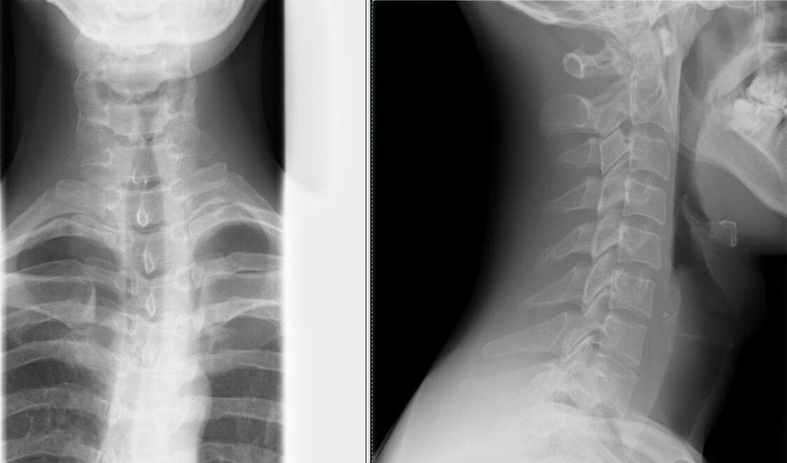 La radiografia della colonna vertebrale è un metodo semplice ed efficace per diagnosticare l'osteocondrosi