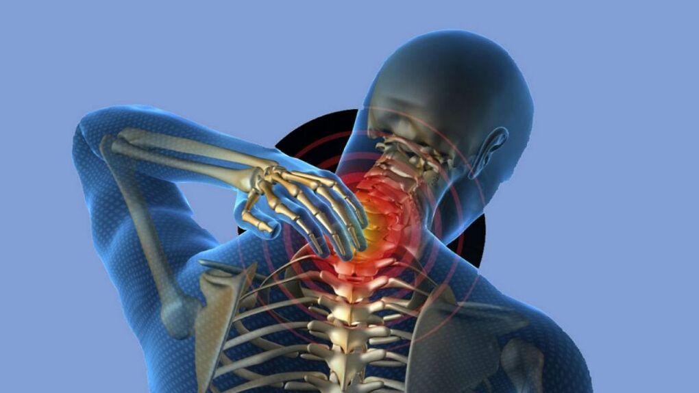 Osteocondrosi della regione di cervice