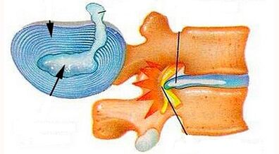 Caratteristiche dello sviluppo dell'osteocondosi in cervice