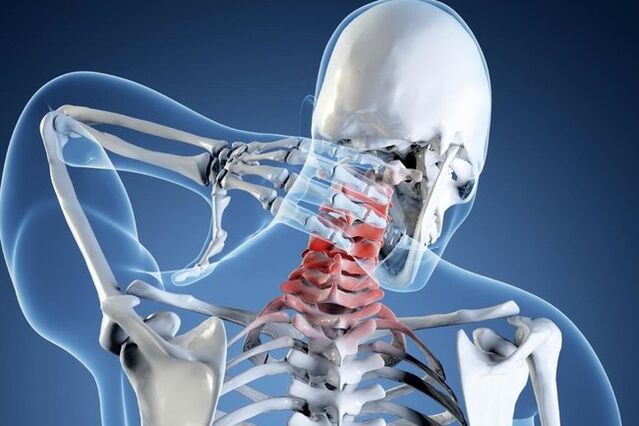 Osteocondrosi del rachide cervicale